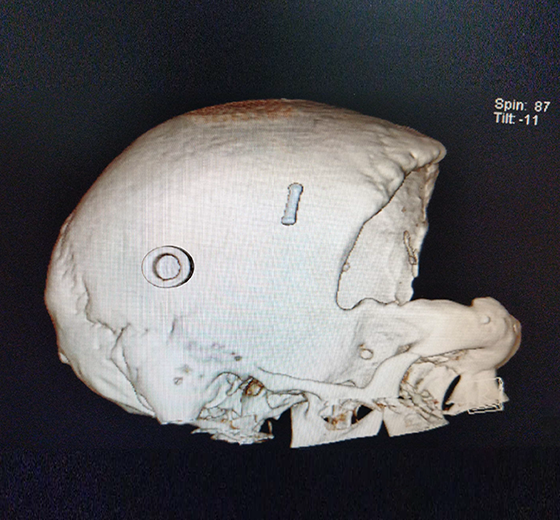 Cranium PEEK implant case 02